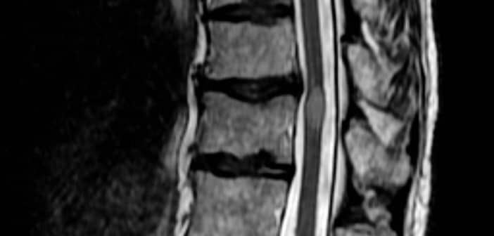 Transverse_myelitis.jpg