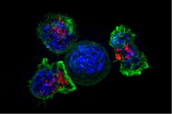 Καρκινικά κύτταρα ανοσοποιητικό: Επιστήμονες αναγνωρίζουν δεκάδες γονίδια -“κλειδιά”