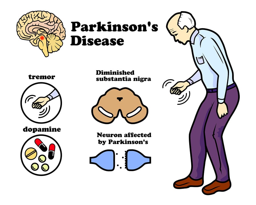 parkinson1.jpg