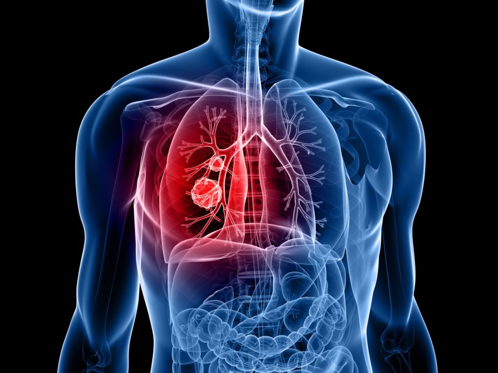 Ανακαλύφθηκε βασικός παράγοντας - υπεύθυνος για τον καρκίνο του πνεύμονα