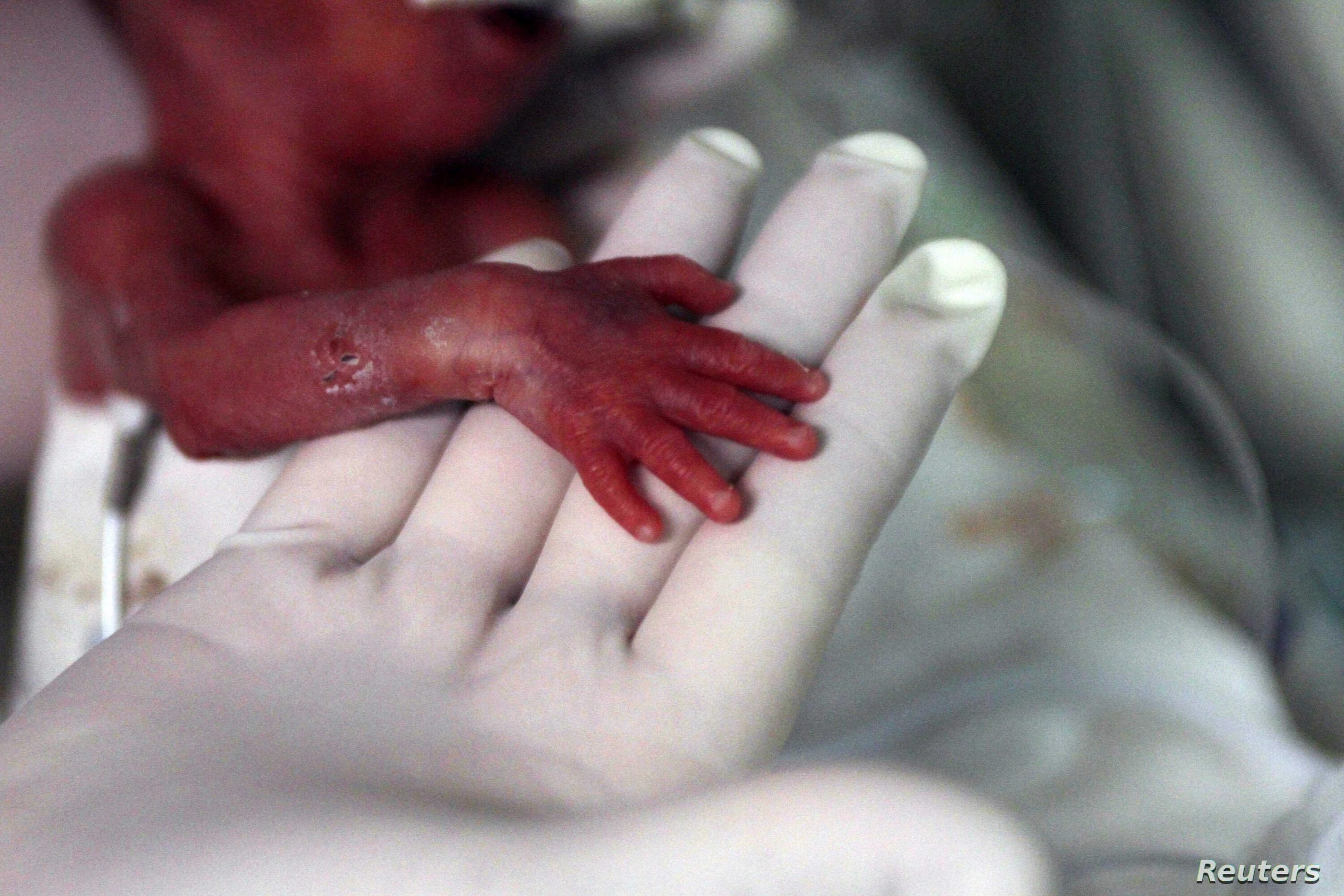 Πρόωρα μωρά: 15 εκατομμύρια σε όλο τον κόσμο γεννιούνται πρόωρα