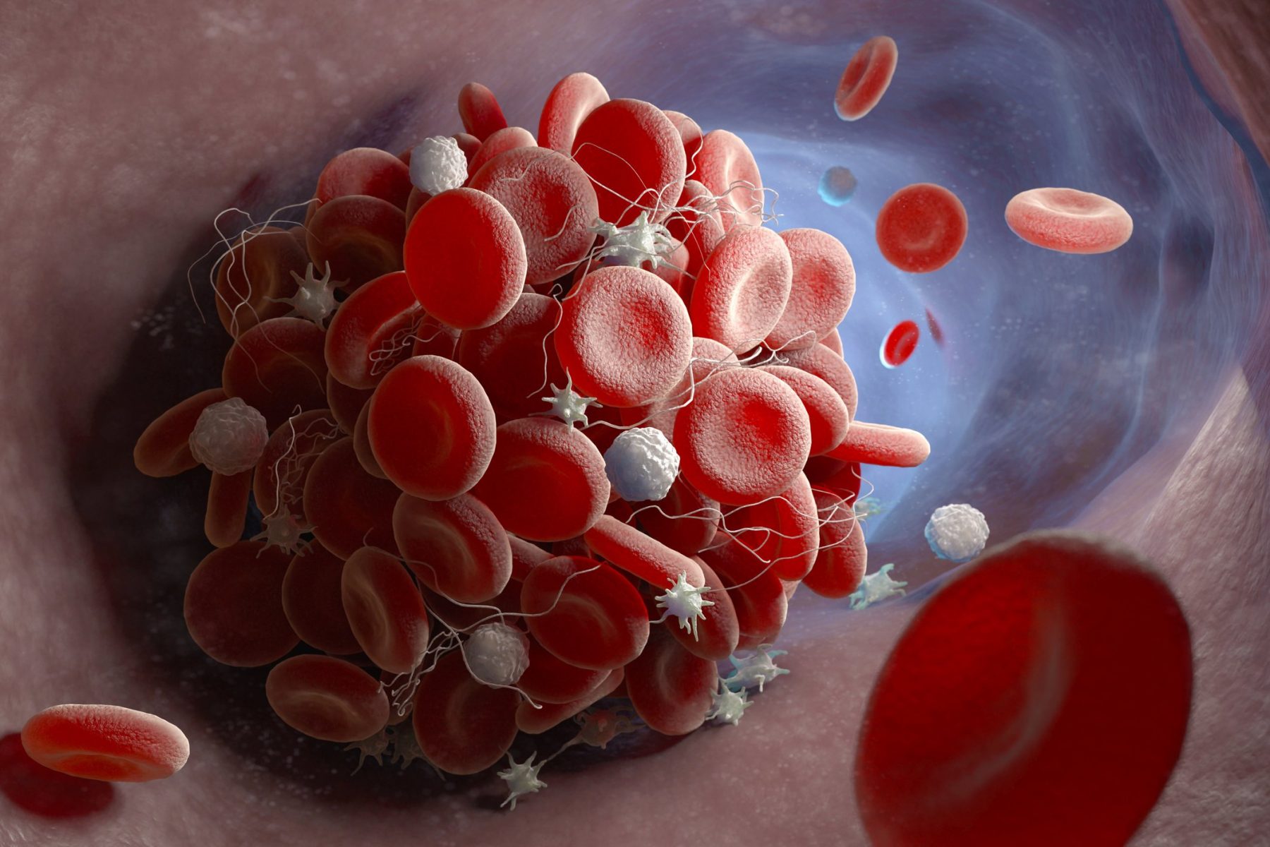 Κορωνοϊός αίμα: Ερευνάται η σχέση covid 19 με τους θρόμβους αίματος