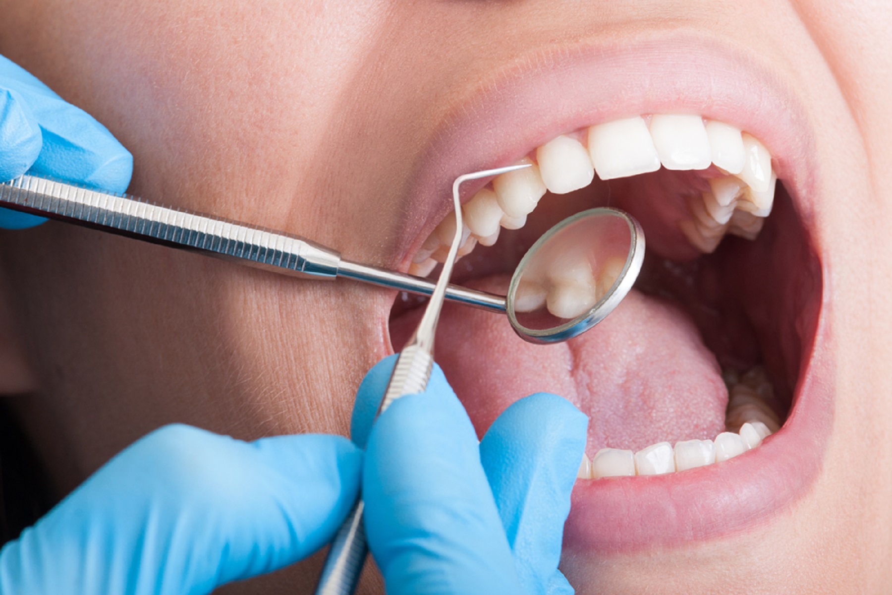 Κορωνοϊός Στόμα: Ενδεχόμενο αναίμακτης απώλειας δοντιών μετά την ανάρρωση από Covid-19
