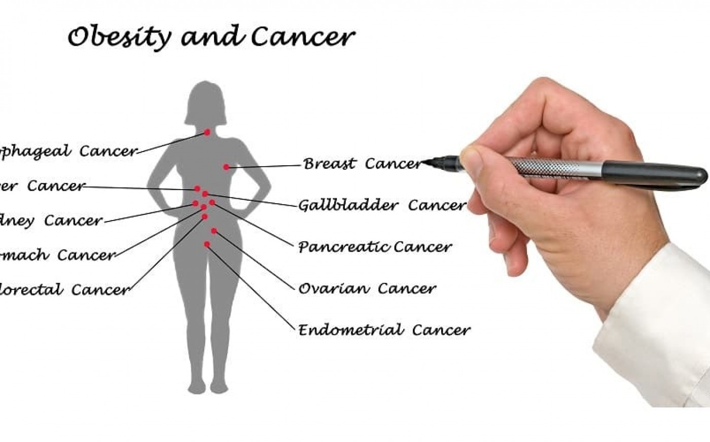 Παχυσαρκία καρκίνος: Η λειτουργία των ανοσοκυττάρων επιταχύνει την ανάπτυξή του όγκου