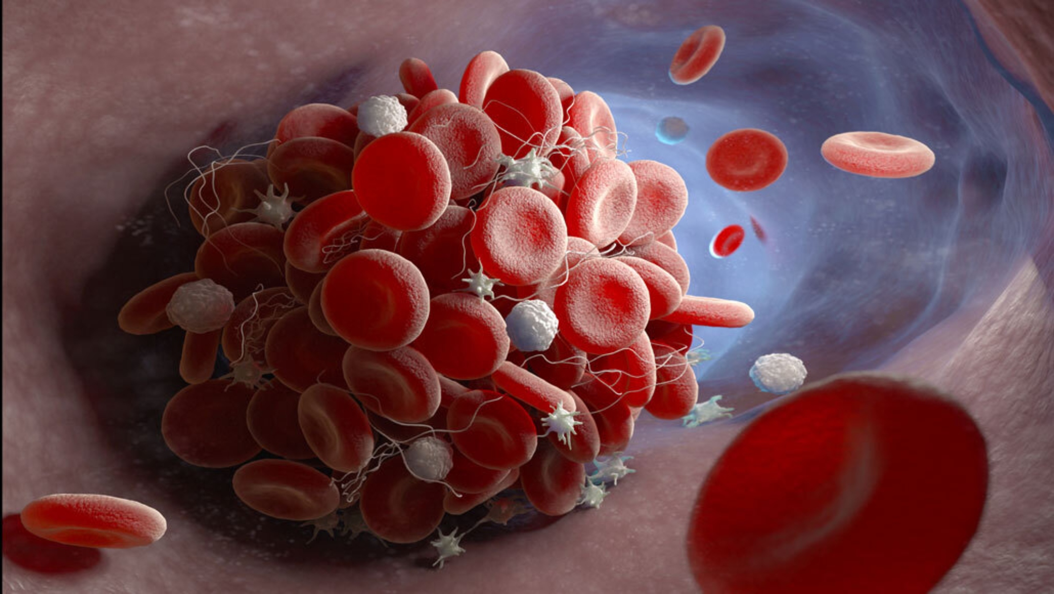 Κορωνοϊός αίμα: Επιτείνει τον κίνδυνο της θρόμβωσης