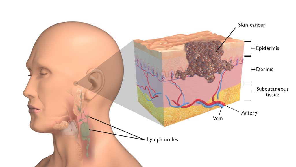 Ερευνητές αναπτύσσουν ένεση για τη θεραπεία του καρκίνου του δέρματος