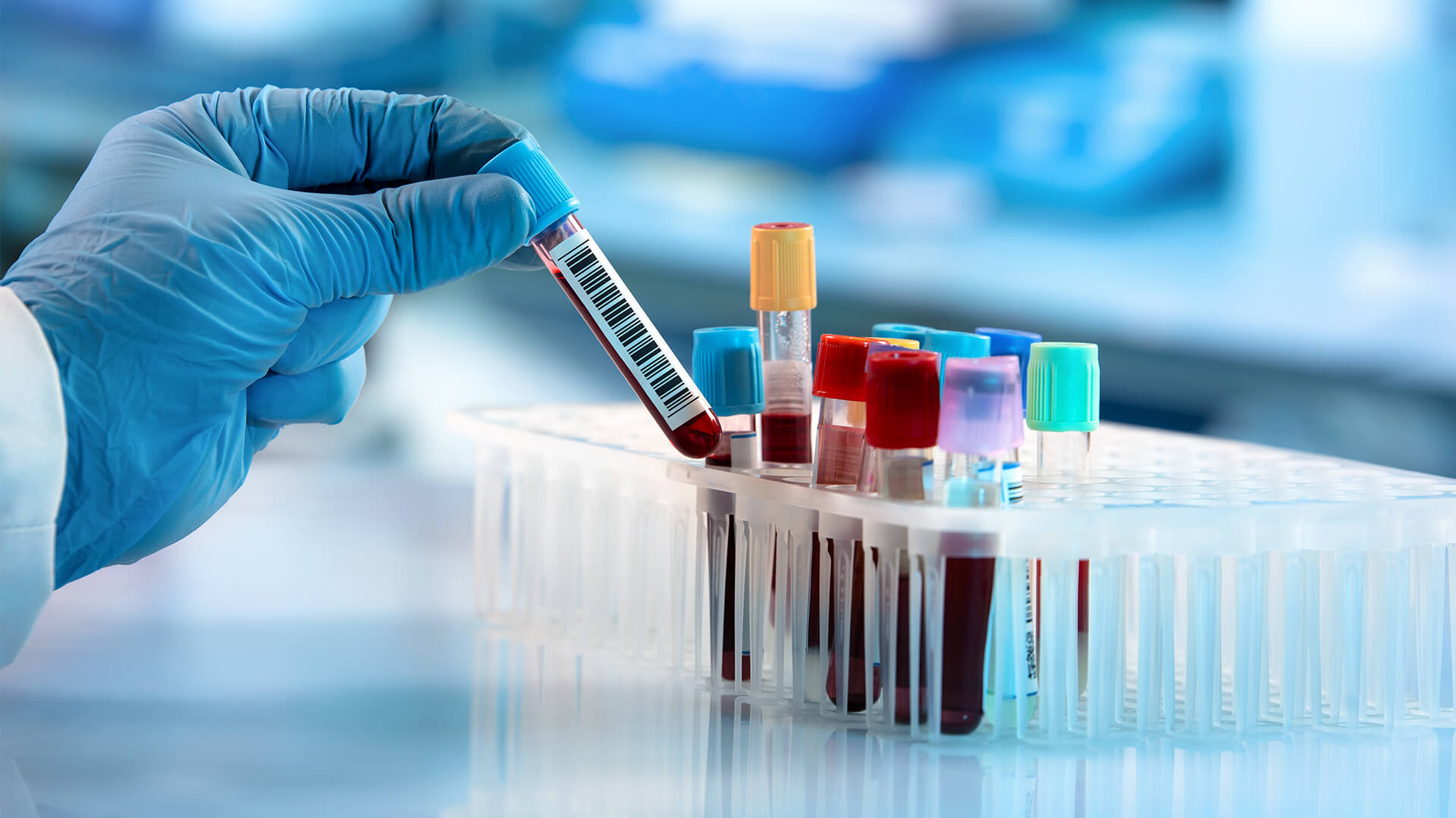Κορωνοϊός Τεστ: Δυνατότητα πρόγνωσης της πορείας της νόσου με αιματολογικές εξετάσεις