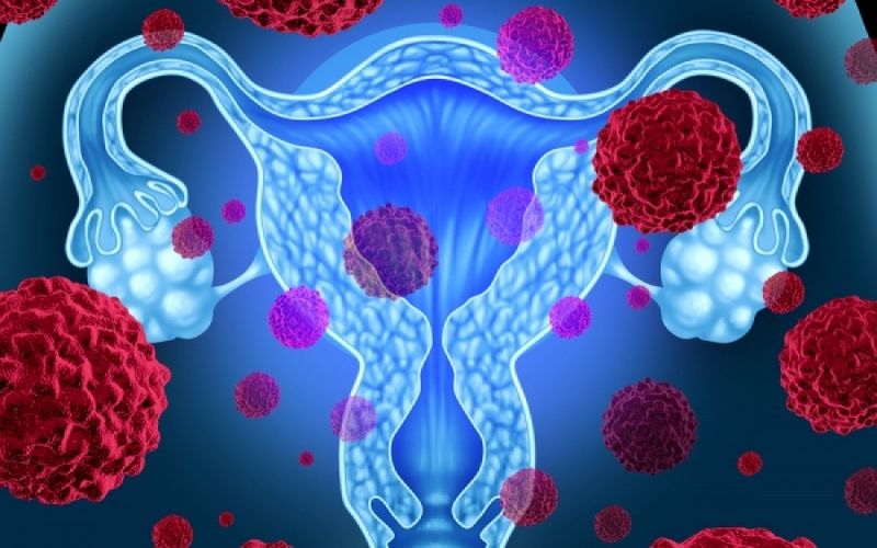 Καρκίνος ωοθήκες: Νέα μελέτη ανακαλύπτει πιθανή μέθοδο έγκαιρης ανίχνευσης