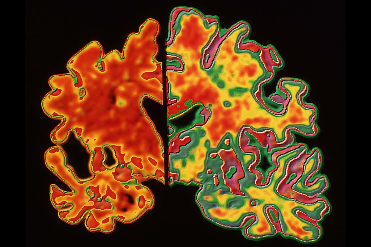 Alzheimer: Η νανοτεχνολογία αρωγός στην έγκαιρη διάγνωση της νόσου