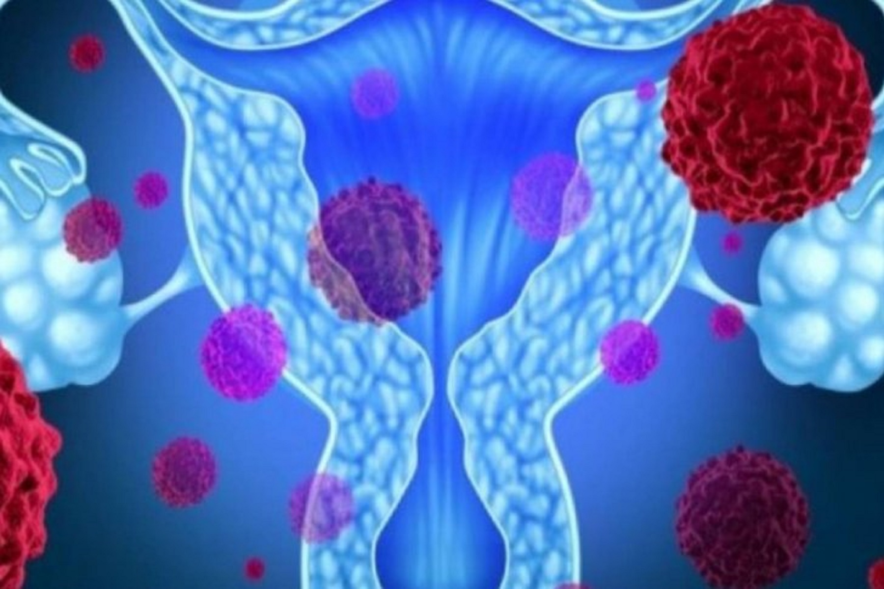 Νέα Έρευνα: Αύξηση της επιβίωσης ασθενών με προχωρημένο καρκίνο στις ωοθήκες