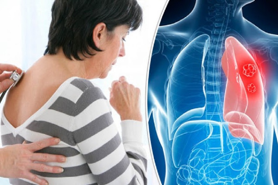 Καρκίνος πνεύμονα: Η επιδιόρθωση του DNA μπορεί να προστατεύει την πλειονότητα των καπνιστών