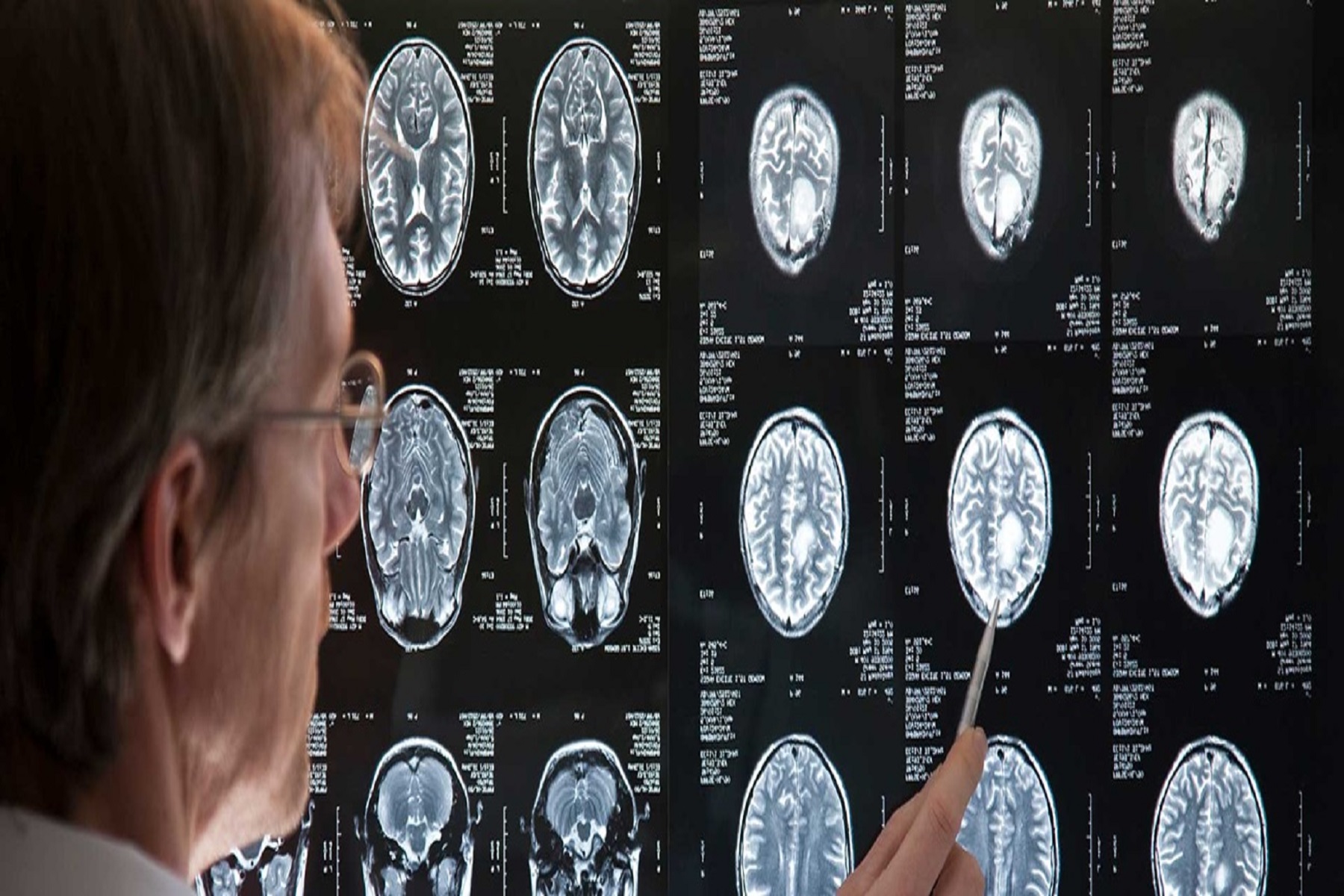 Έρευνα Βερολίνο: Προστατευτικός μηχανισμός εγκεφάλου μετά από νευρολογικό τραυματισμό ή ασθένεια