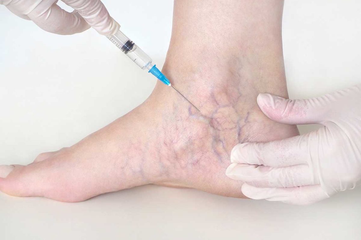 Κιρσοί πόδια φλέβες κίνδυνοι: Ποιοι κίνδυνοι συνδέονται με την εμφάνιση κιρσών στα πόδια;