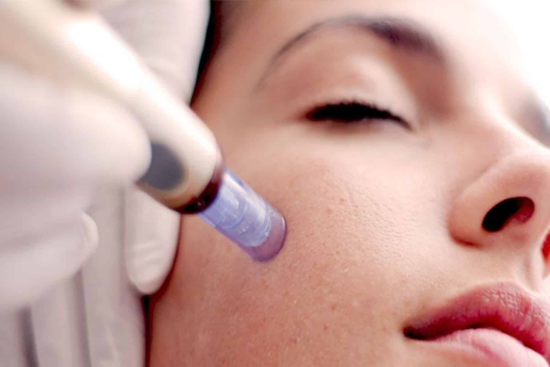 Microneedling : Η Θεραπεία που λέει αντίο στην γήρανση