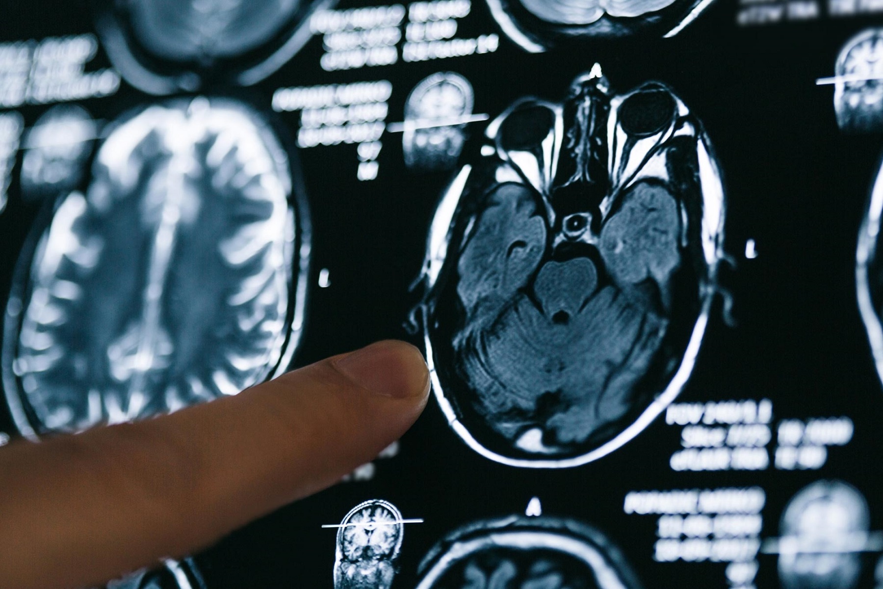 Ερευνητές Πανεπιστήμιο Οξφόρδη: Οι εγκεφαλικές σαρώσεις των ασθενών από κορωνοϊό υποδηλώνουν «σημαντική» απώλεια φαιάς ουσίας με την πάροδο του χρόνου