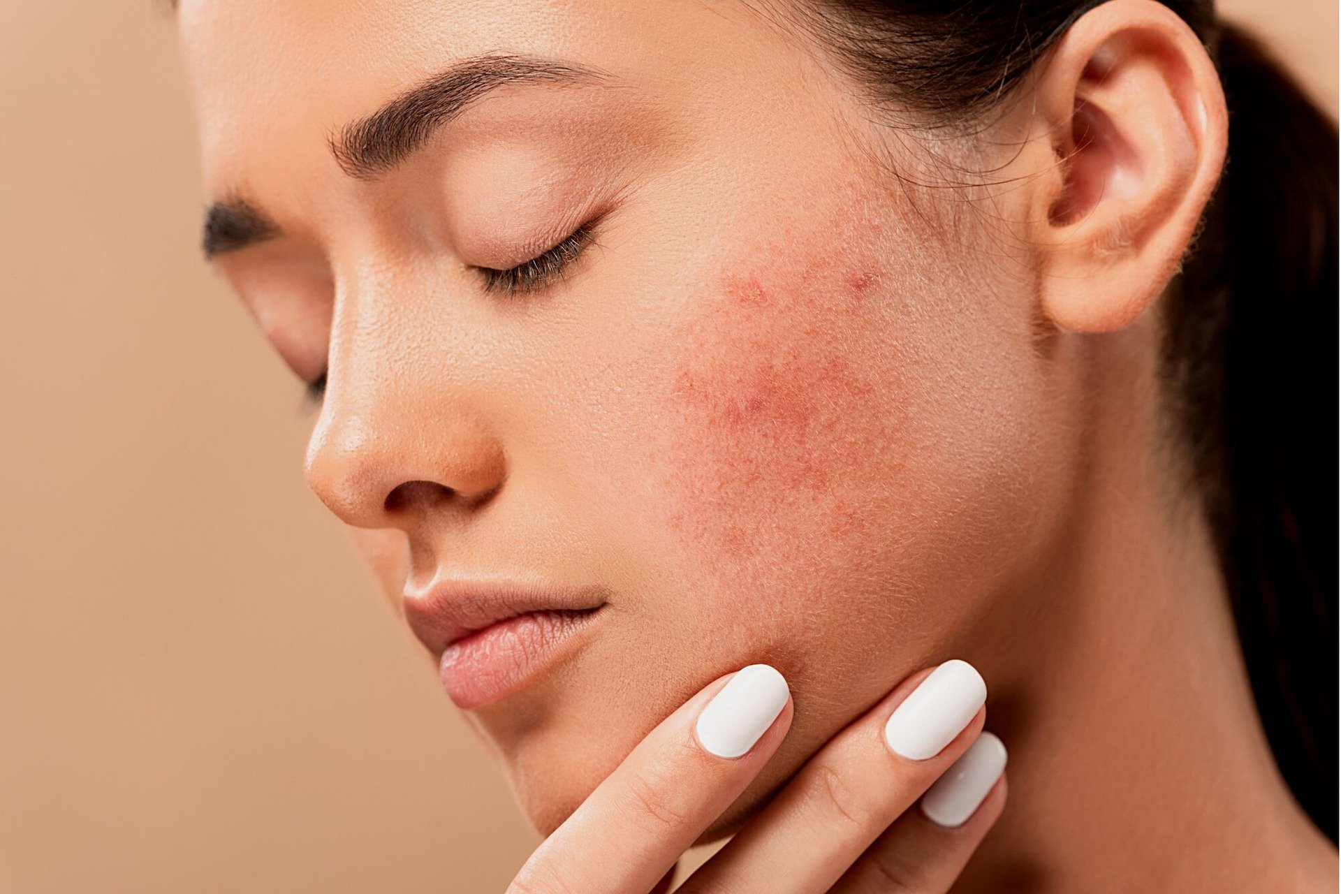 Ακμή: 5 κοινές συνήθειες στη φροντίδα του δέρματος που επιδεινώνουν την ακμή [vid]