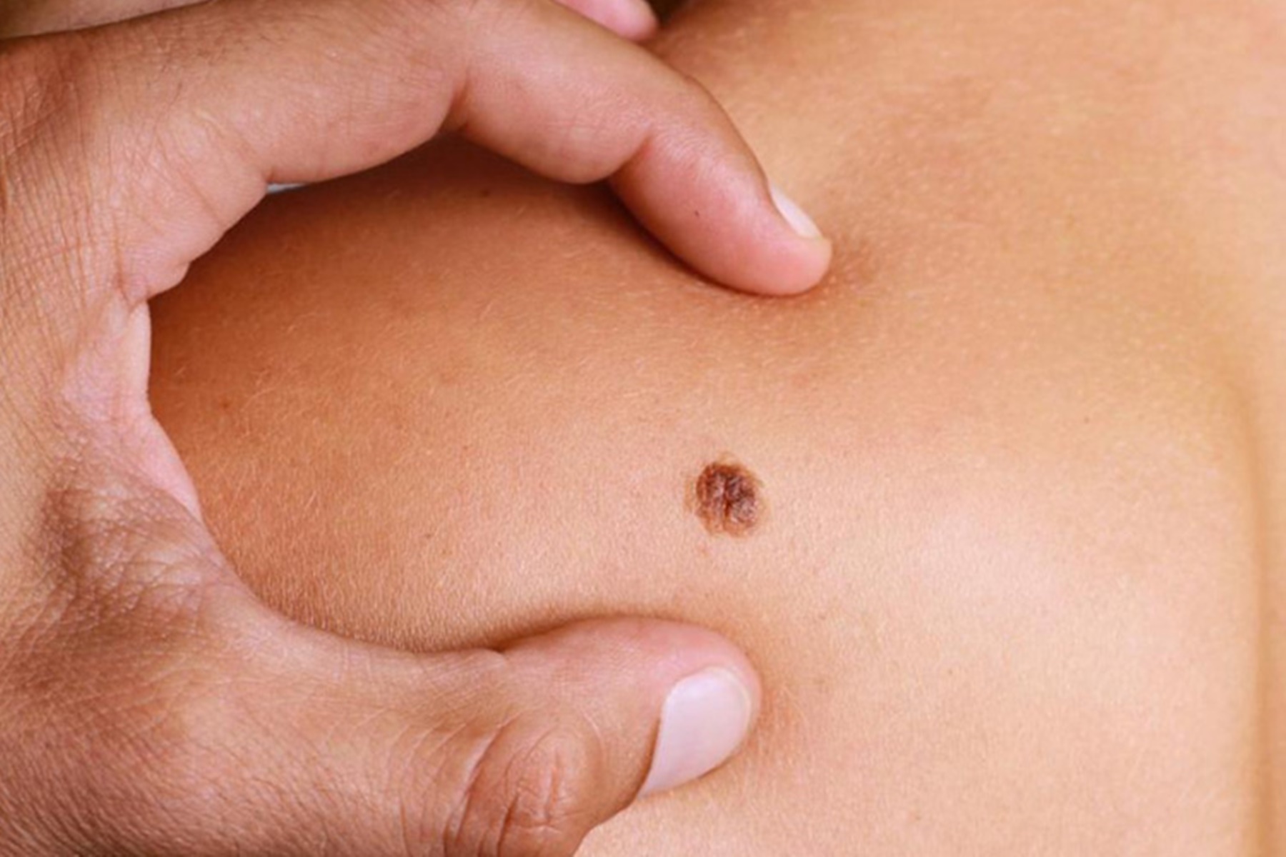 Καρκίνος δέρματος : Καμπάνια πρόληψης “Μια ελιά μπορεί να κάνει την διαφορά”