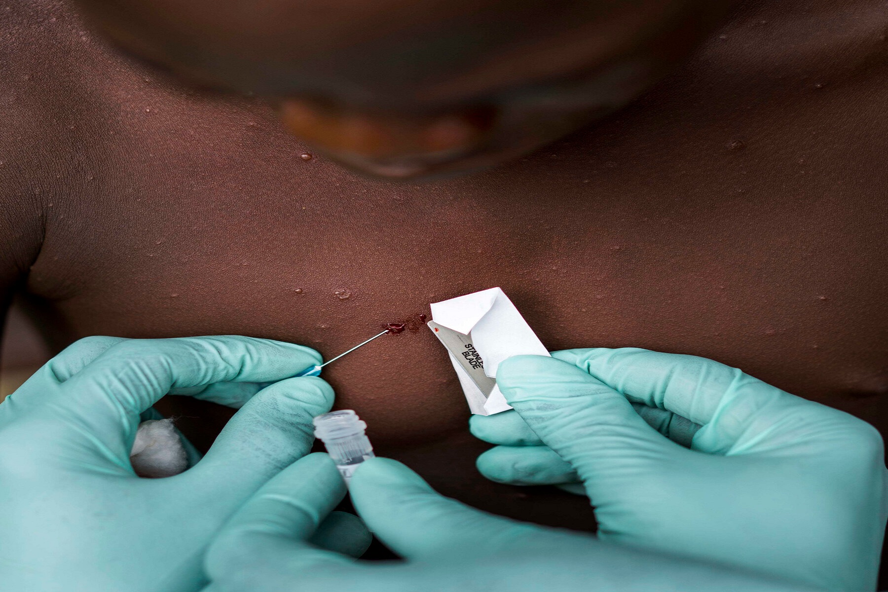 CDC: Πανώλη εντοπίστηκε σε νοσοκομειακό ασθενή των ΗΠΑ που επισκέφθηκε τη Νιγηρία