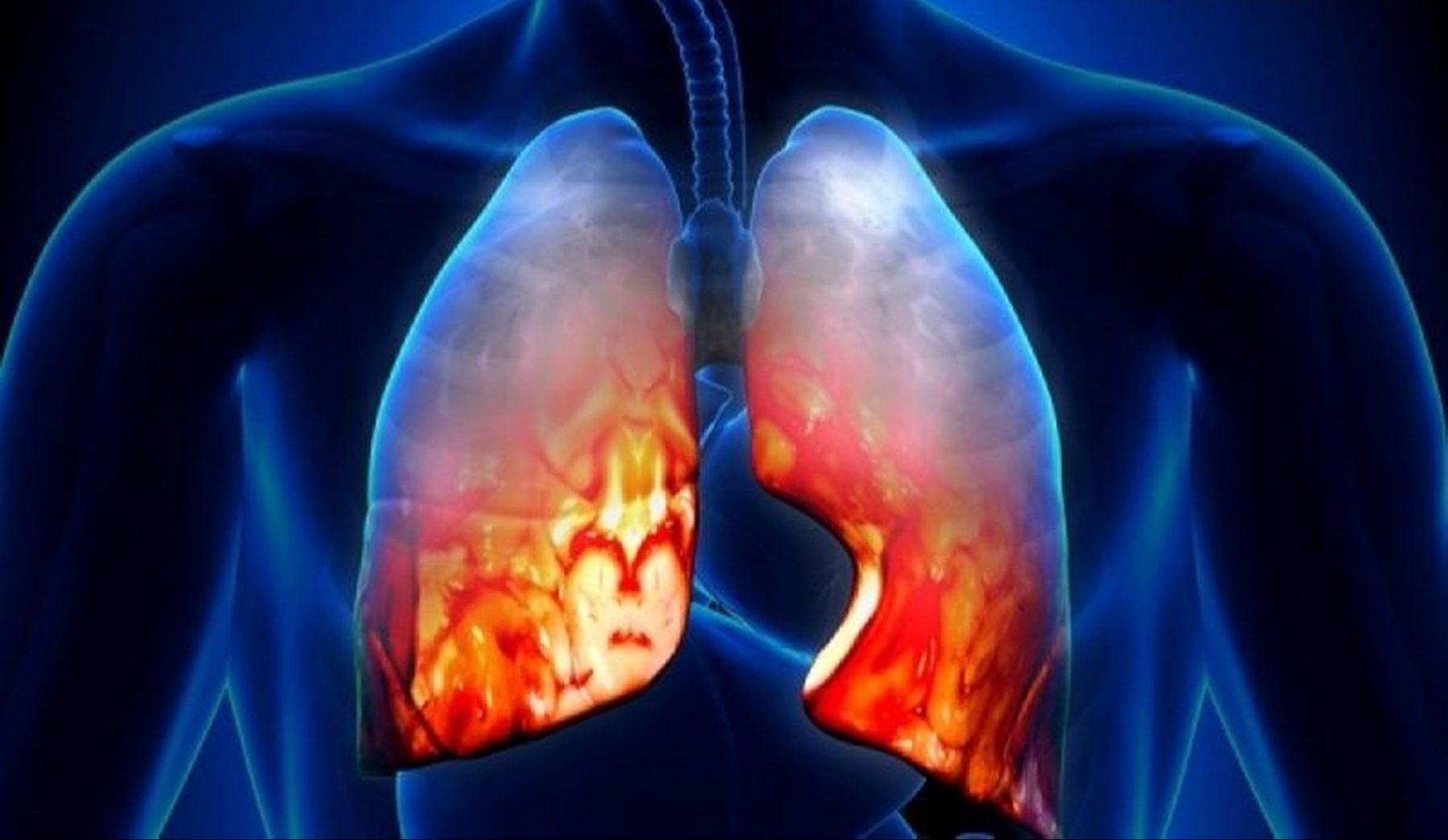 Πνευμονία : Δείτε τα συμπτώματα που προκαλεί