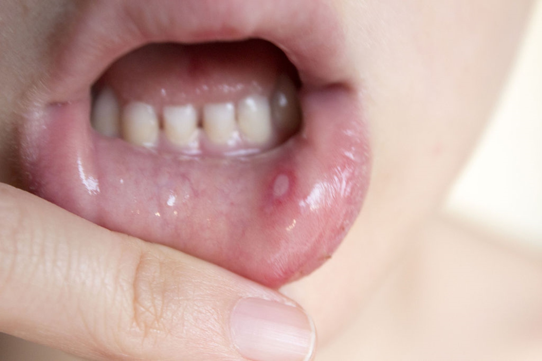 Πληγές στόμα : Λόγοι που συμβαίνουν