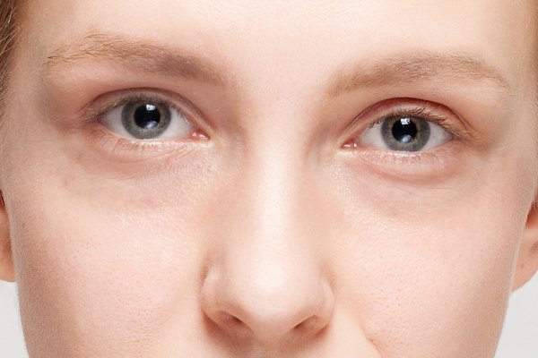 Μαύροι κύκλοι: DIY αντιγηραντική κρέμα ματιών με καφέ για ξεκούραστο βλέμμα