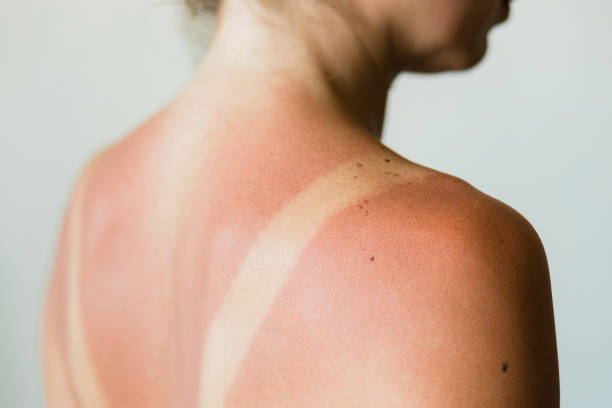 Δέρμα Ήλιος: Πώς να περιποιηθείτε το ηλιοκαμένο δέρμα στο σπίτι