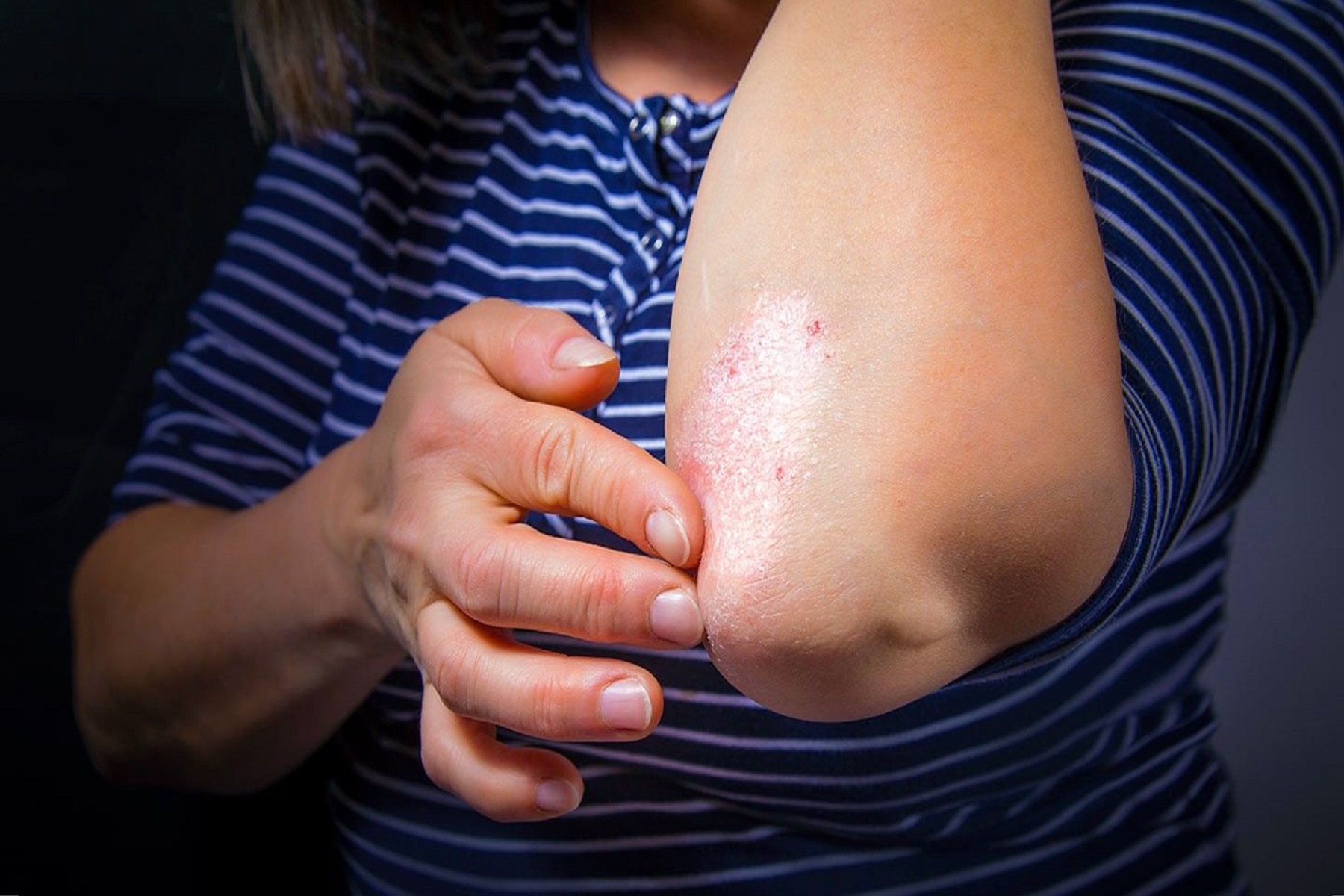 Δέρμα Ψωρίαση: Τι είδους κρέμες μπορούν να βοηθήσουν στη θεραπεία της