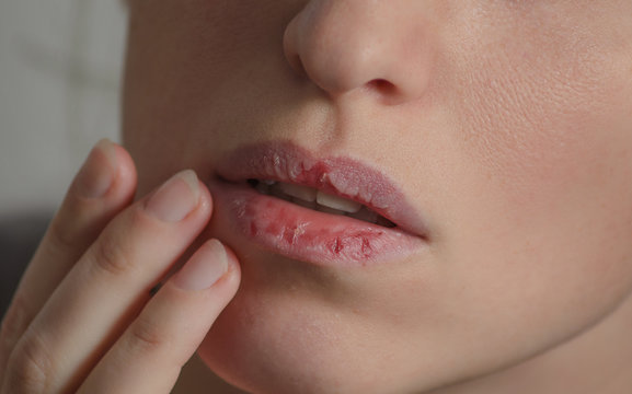 Σκασμένα χείλη θεραπεία: Εύκολες DIY θεραπείες για τα σκασμένα χείλη