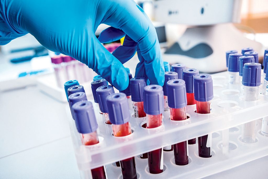 Μια νέα εξέταση αίματος μπορεί να εντοπίσει περισσότερο από το 80% των ανθρώπων με αυξημένη πιθανότητα να αναπτύξουν τη νόσο αλτσχέιμερ