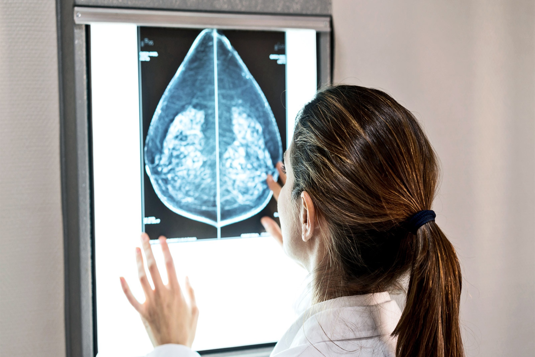 Μηχανική μάθηση υγεία: Το machine learning επιτρέπει την βέλτιστη ταξινόμηση του καρκίνου μαστού