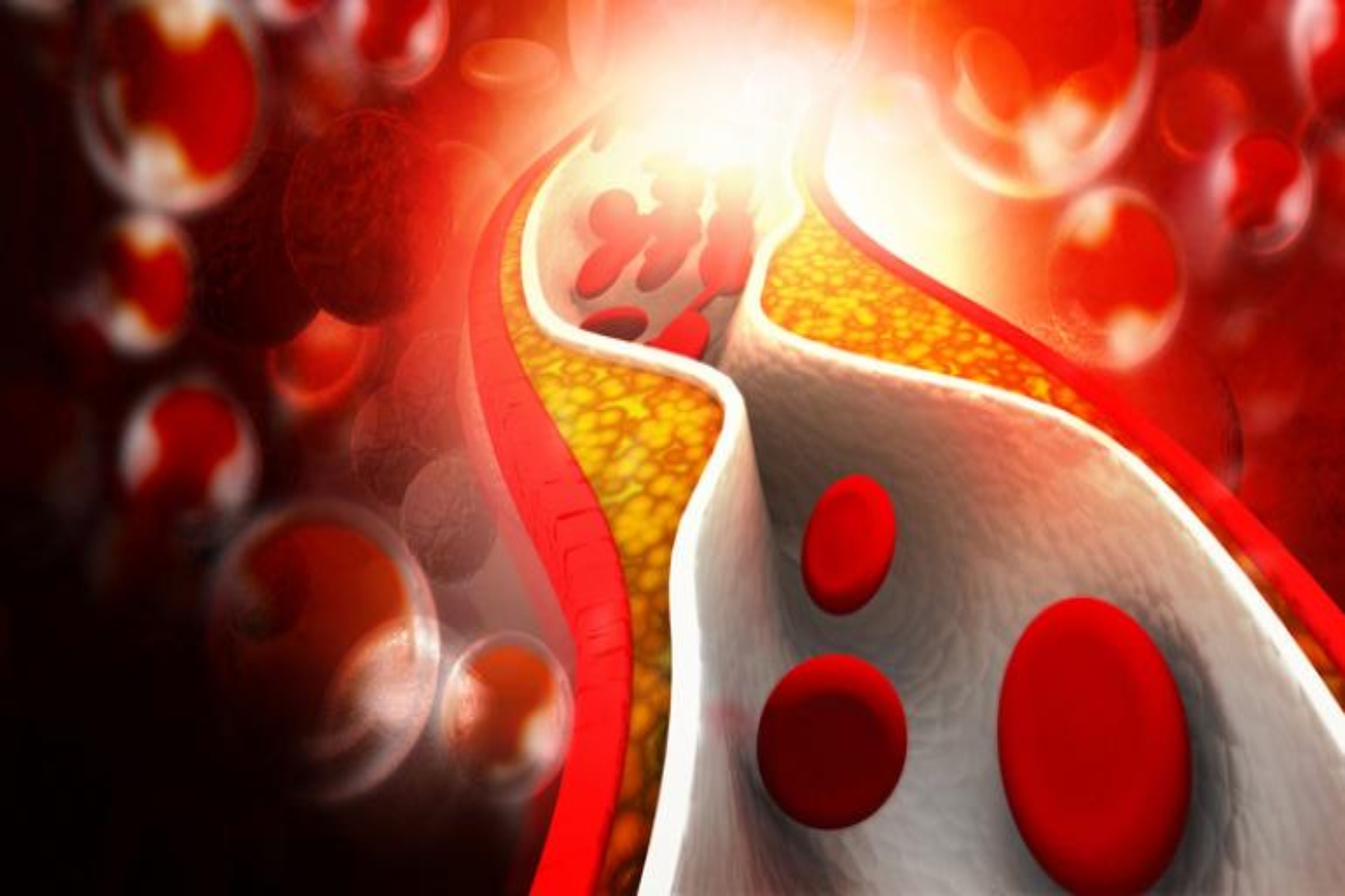 Βιταμίνη Κ2 καρδιά: 34% χαμηλότερος κίνδυνος καρδιακής νόσου με επαρκή λήψη Κ2
