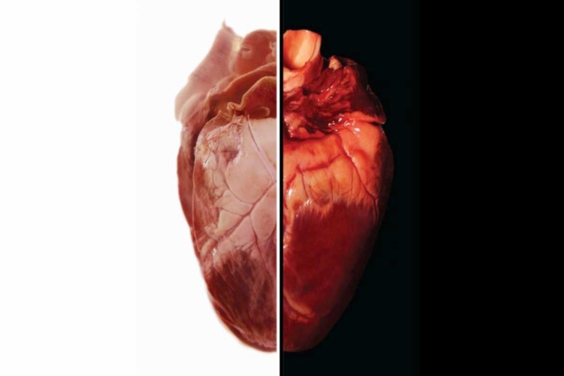 Μεταμόσχευση καρδιάς χοίρου: Η εξέλιξη προκαλεί αισιοδοξία αλλά και ανησυχία