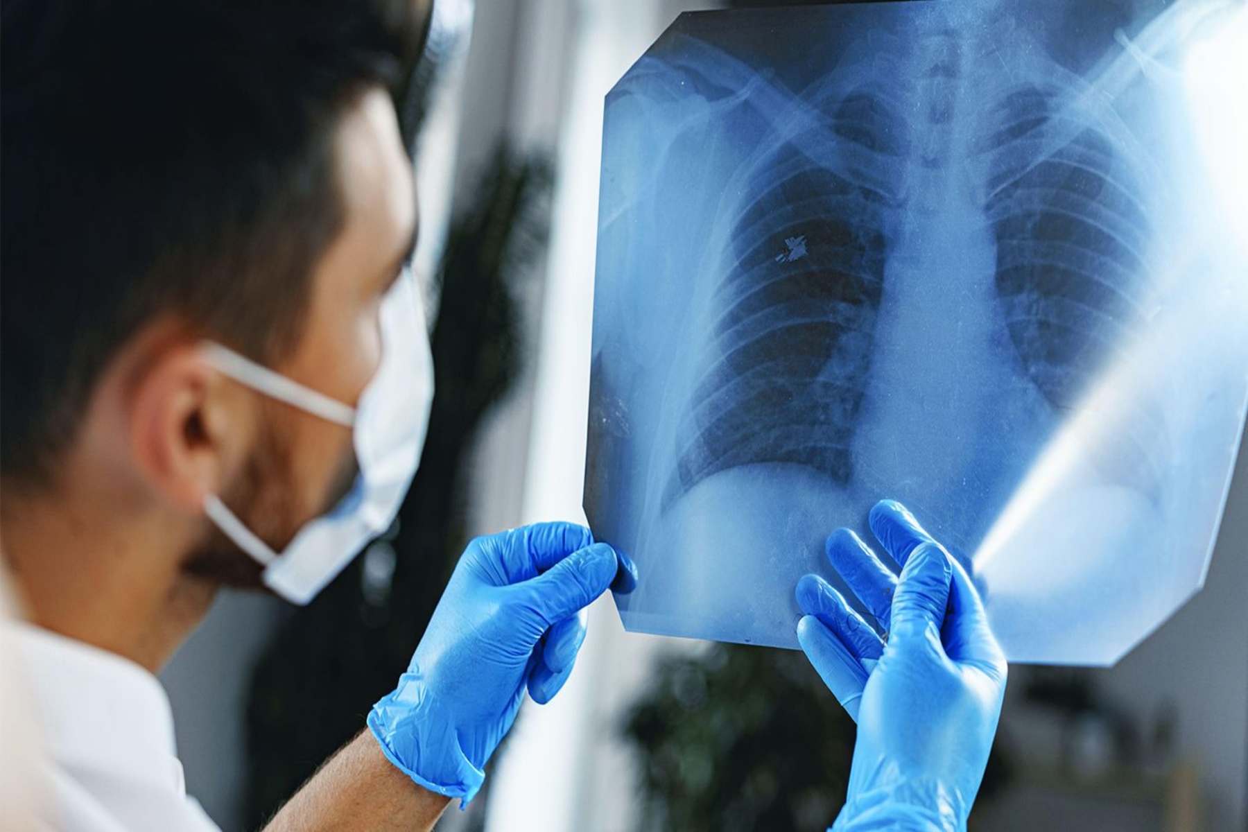 Μικροκυτταρικός καρκίνος του πνεύμονα: Νέα μελέτη ανοίγει τον δρόμο προς τη θεραπεία