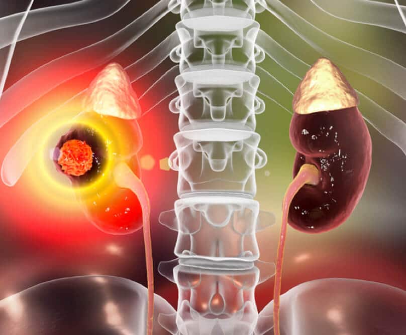 Καρκίνος νεφρού: Ένας σιωπηλός εχθρός.Συμπτώματα-Θεραπεία