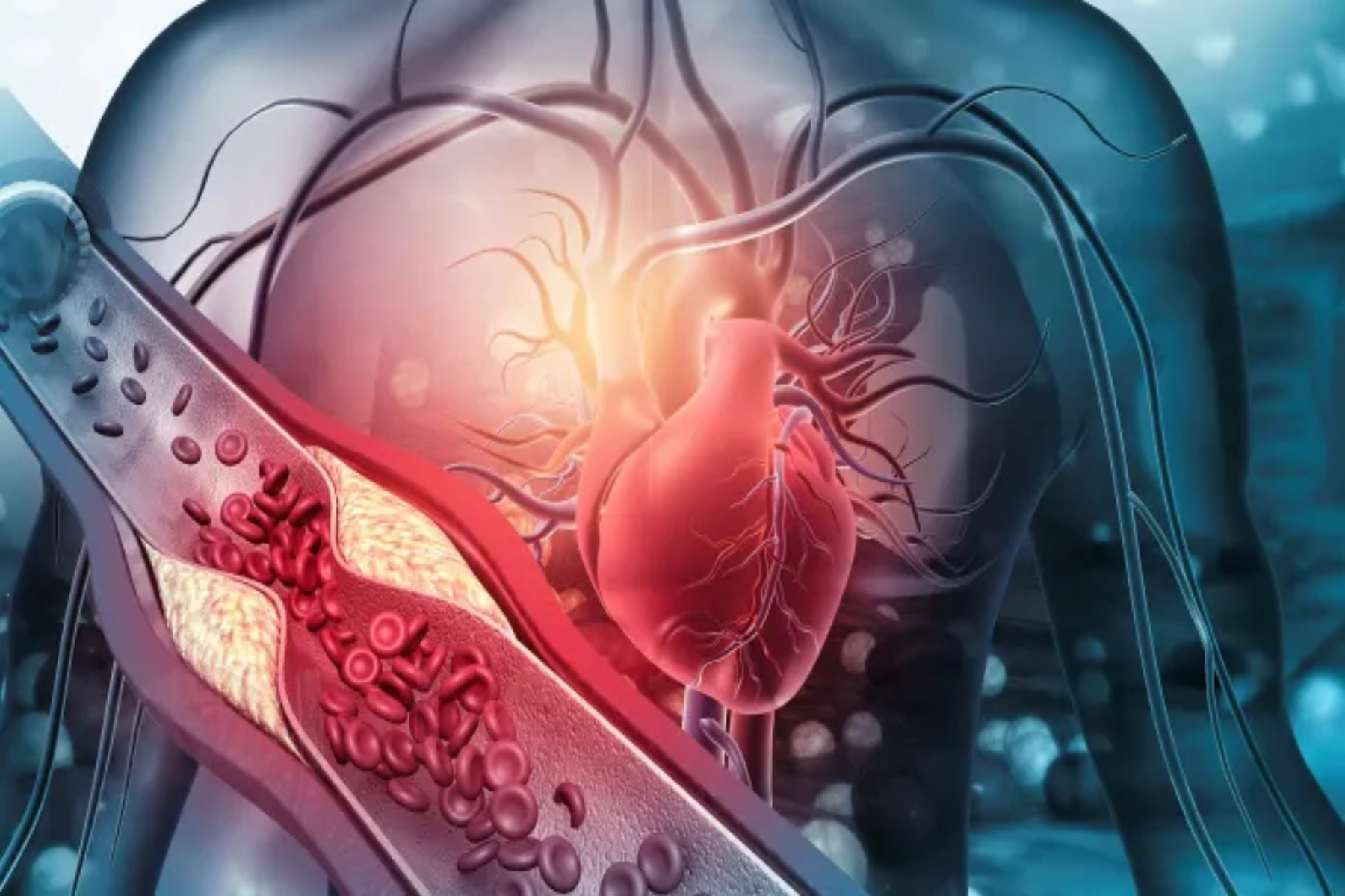 Καρδιά χοληστερίνη: Ασυνεπής η σχέση μεταξύ υψηλής χοληστερόλης και καρδιακής νόσου
