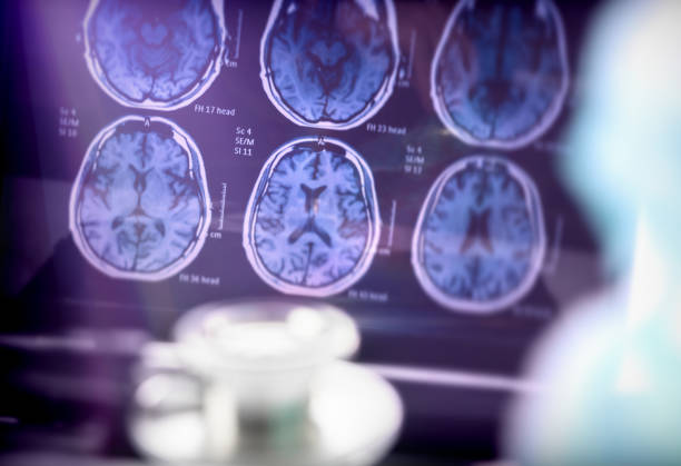 Νόσος Αλτσχάιμερ: Επηρεάζει τις περισσότερες βιολογικές οδούς του εγκεφάλου
