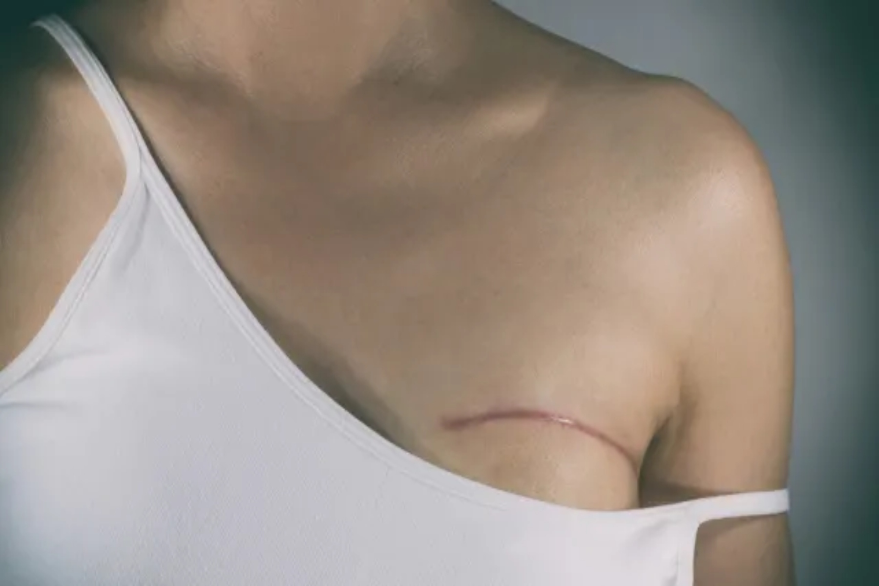 Σεξ μαστεκτομή: Πώς η μαστεκτομή & η αποκατάσταση των μαστών επηρεάζουν την σεξουαλική μας ζωή