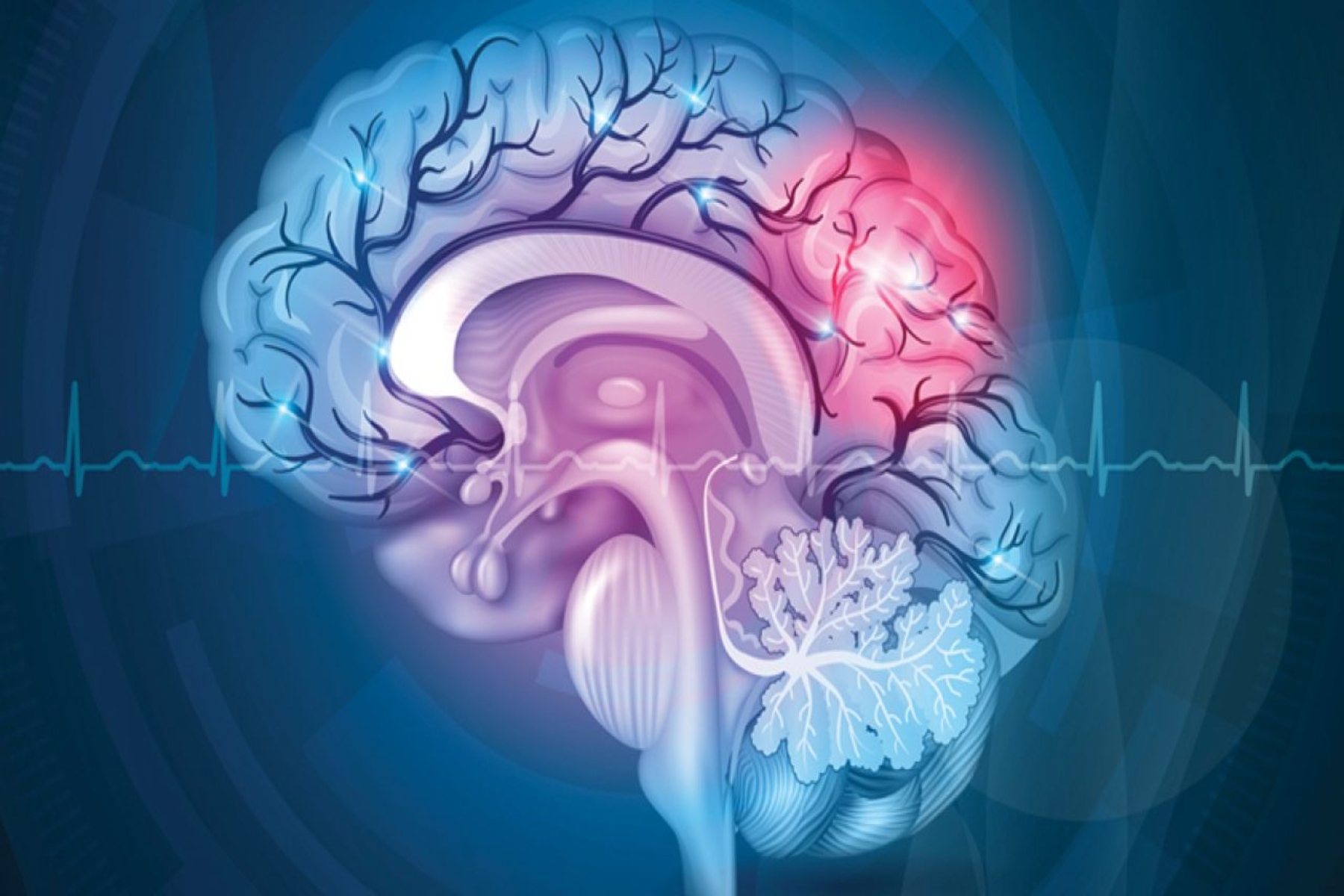 Εγκεφαλικό: Πώς να αποτρέψετε το επαναλαμβανόμενο εγκεφαλικό όταν η αιτία είναι άγνωστη
