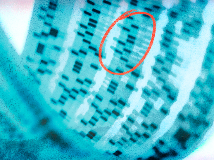Νόσος Πάρκινσον: Ανακαλύφθηκαν νέοι DNA παράγοντες κινδύνου
