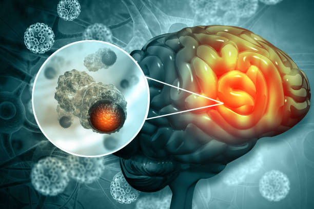 Καρκίνος εγκεφάλου: Νέα μελέτη ρίχνει φως στους παράγοντες που διαμορφώνουν την υποτροπή