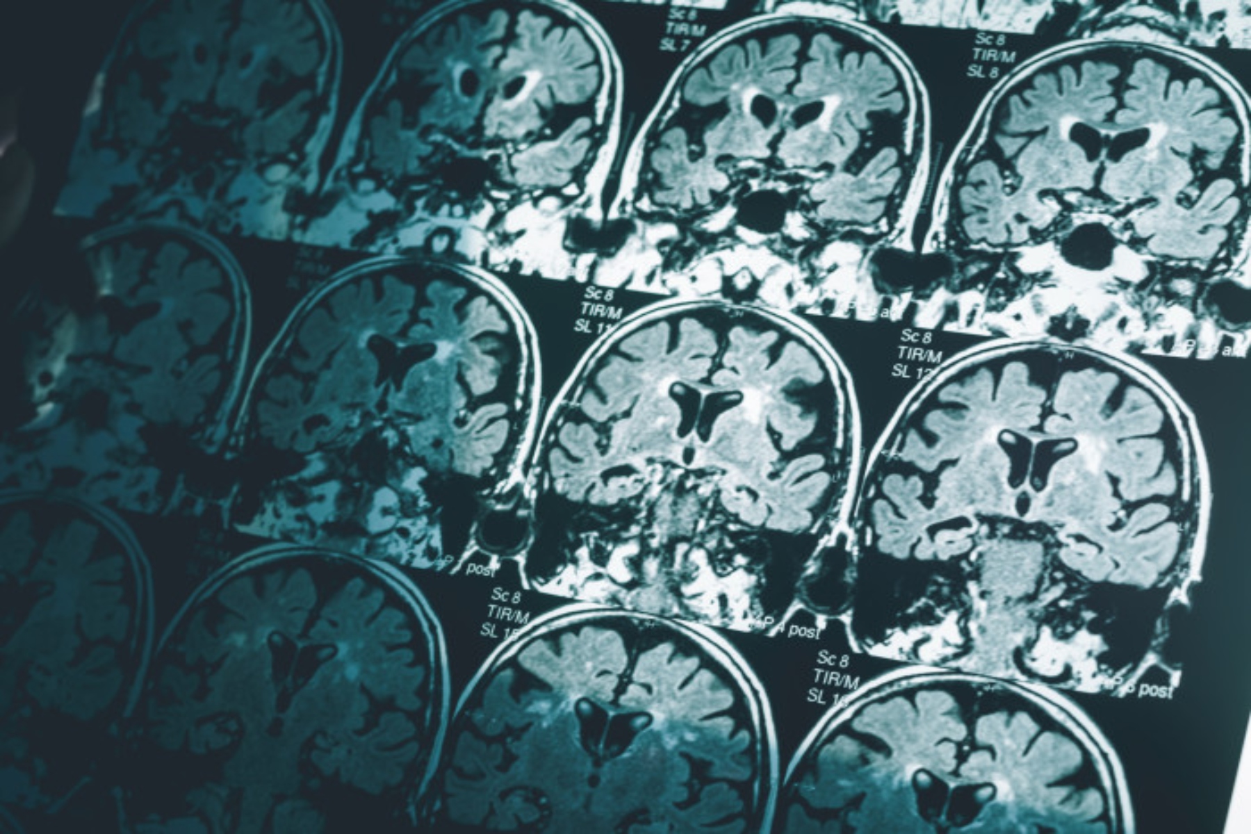 Αλτσχάιμερ: Μια απλή σάρωση εγκεφάλου μπορεί να διαγνώσει τη νόσο
