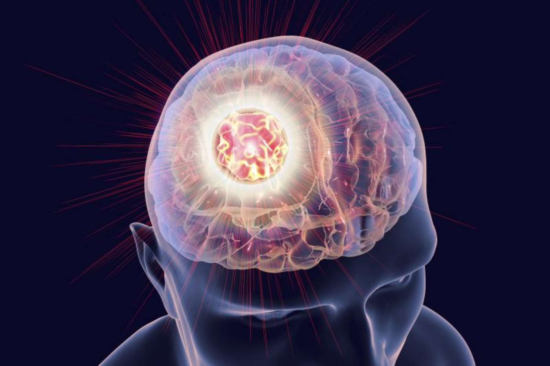 Μελάνωμα μετάσταση: Νέες πληροφορίες για τις μεταστάσεις μελανώματος στον εγκέφαλο
