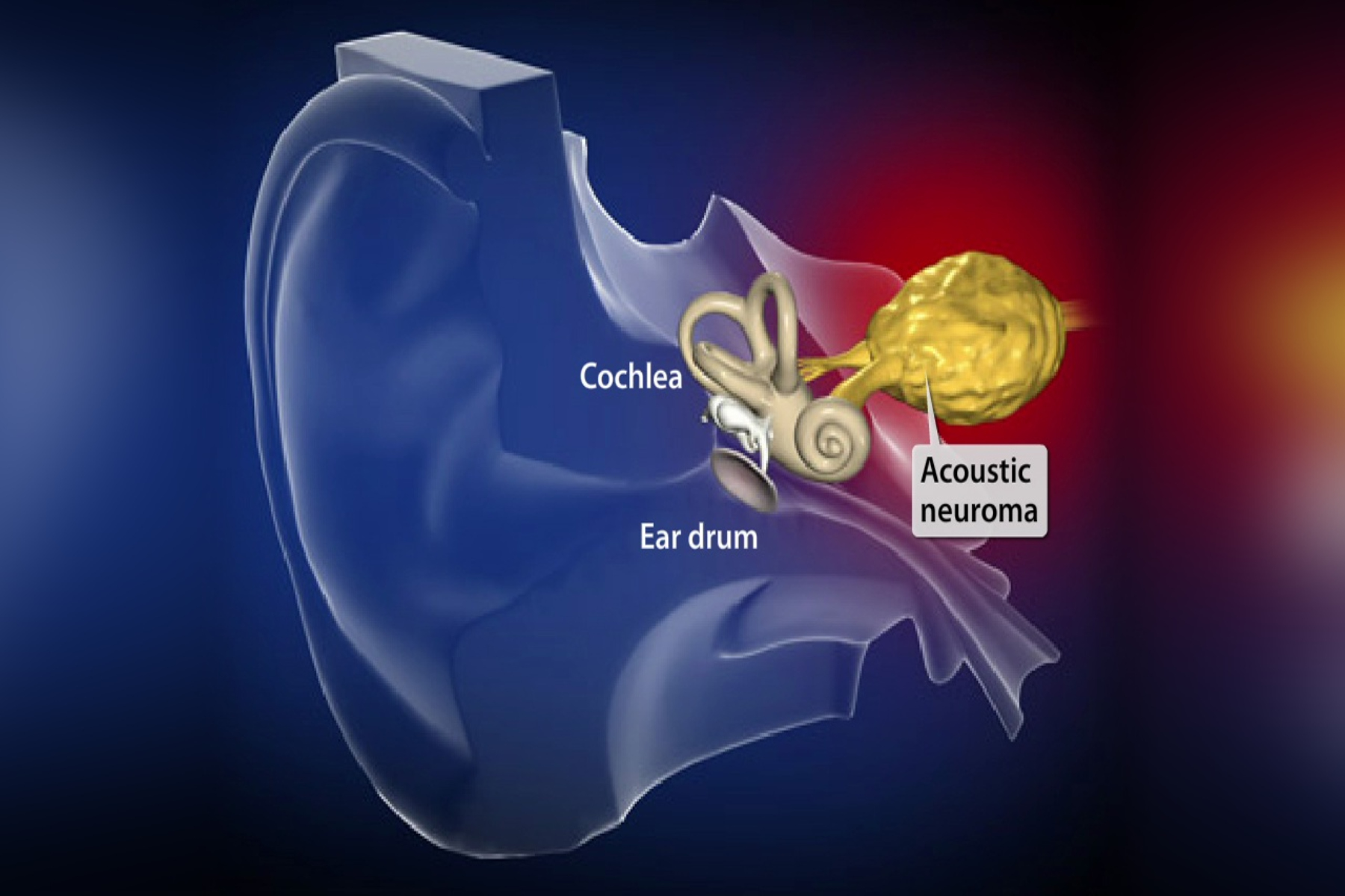 Ακουστικό νευρίνωμα: Πώς δημιουργείται ο καλοήθης πρωτοπαθής ενδοκράνιος όγκος;