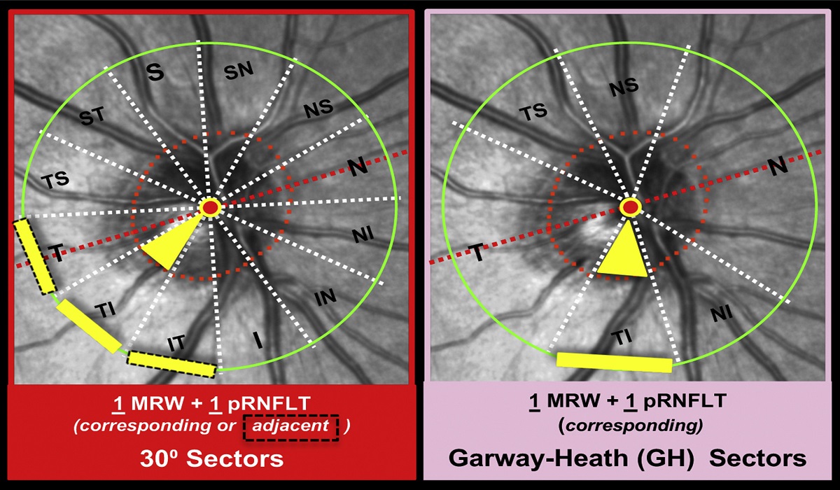 Νέα τεχνολογία: Απεικόνιση δεσμίδων αξονικών ινών στον αμφιβληστροειδή για την έγκαιρη διάγνωση οπτικών νευροπαθειών