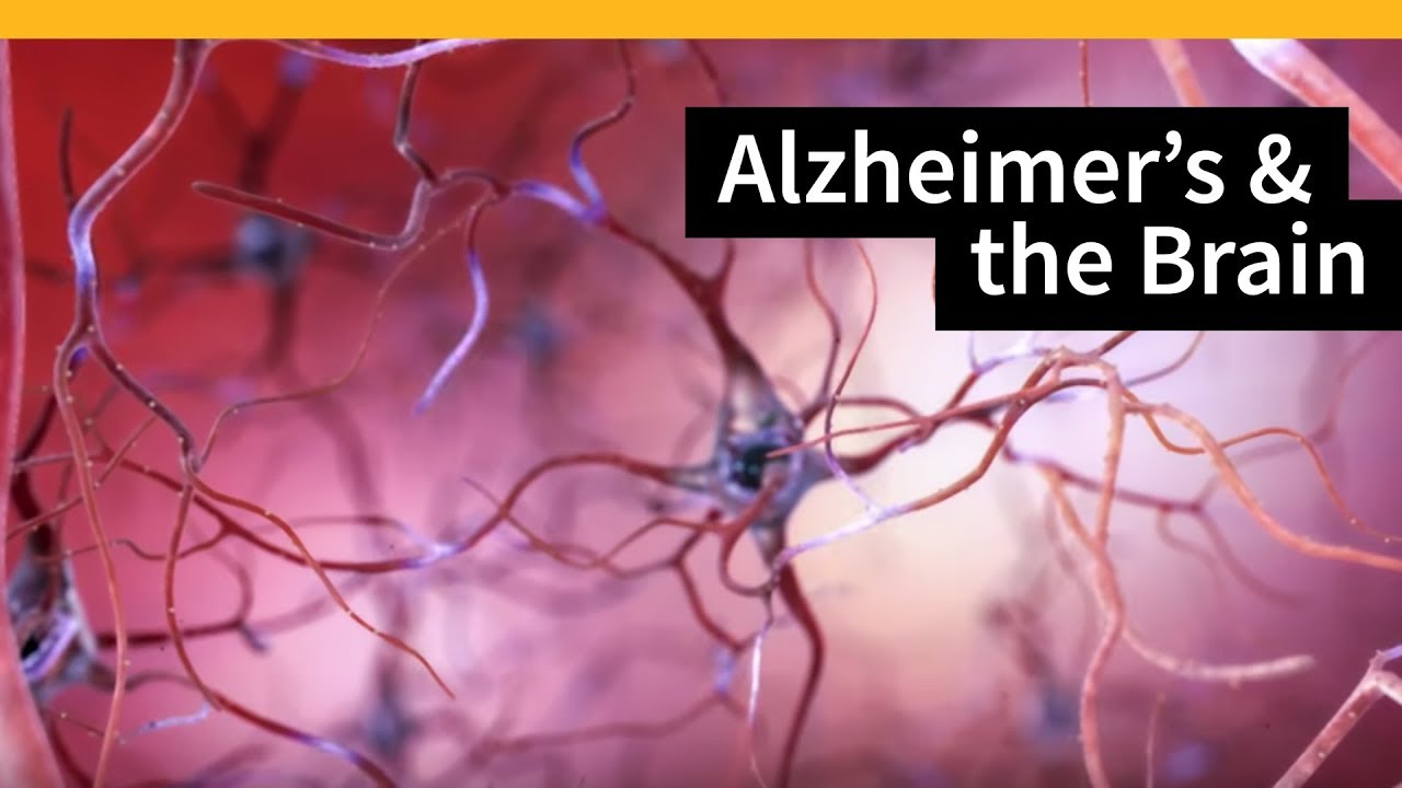Αλτσχάιμερ: Η εύρεση της διαδρομής της νόσου μέσα στο σώμα θα μπορούσε να οδηγήσει σε θεραπείες
