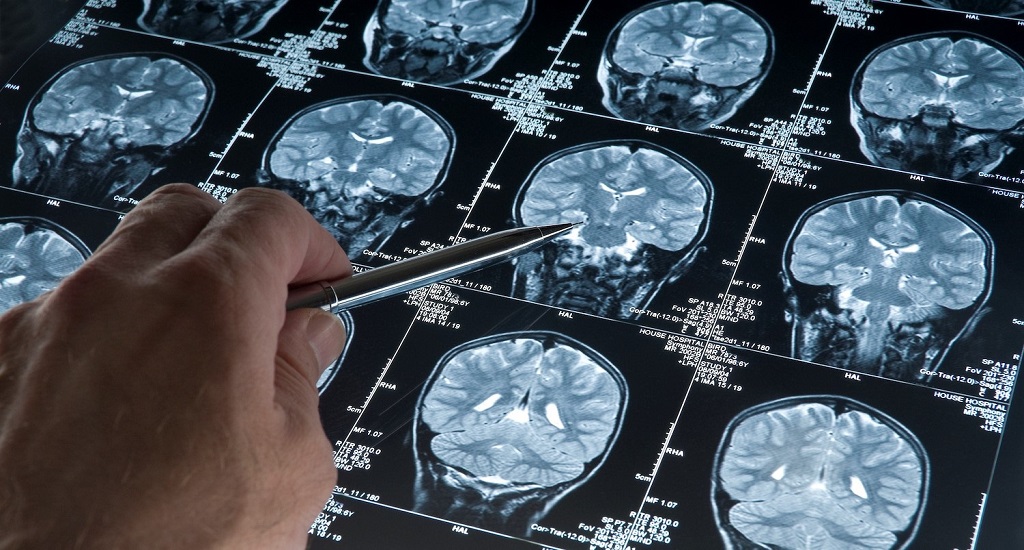 Πανεπιστήμιο του Σασκάτσουαν: Χτυπώντας τον καρκίνο του εγκεφάλου με μακριές βελόνες ανοίγει η πόρτα σε νέες θεραπείες