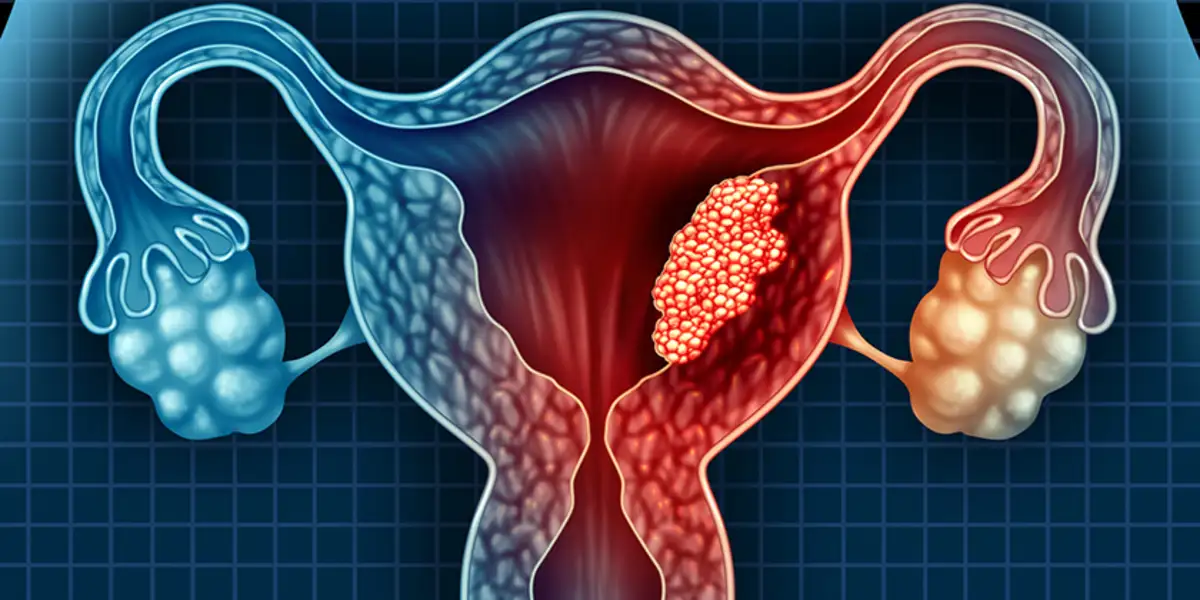 Νέα Θεραπευτική Στρατηγική: Για τη βελτίωση της θεραπείας του επιθετικού καρκίνου του ενδομητρίου