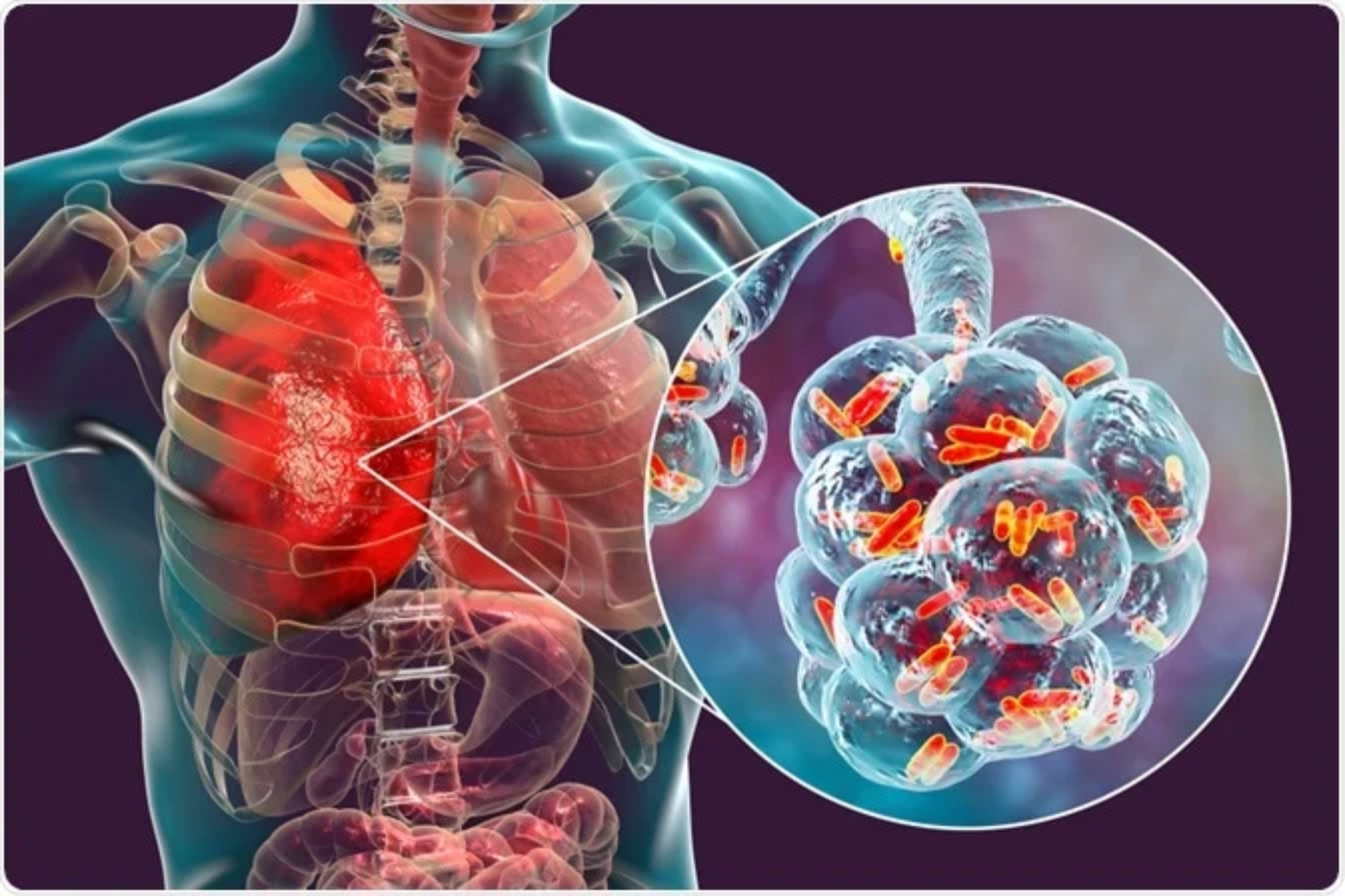 Παγκόσμια Ημέρα Πνευμονίας: Μάθετε πώς να εντοπίζετε τα πρώτα σημάδια της νόσου