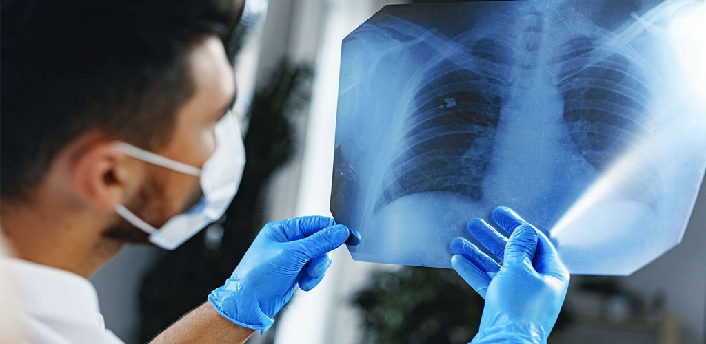 Καρκίνος του Πνεύμονα: Απαραίτητος ο ετήσιος προσυμπτωματικός έλεγχος με αξονική τομογραφία θώρακος (LDCT)