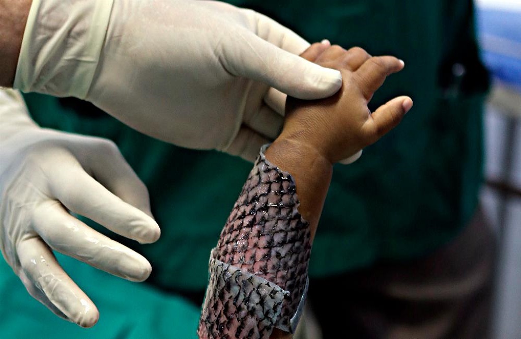 Ερευνητής της Urgo δείχνει πληγή που θα μπορούσε να αντιμετωπιστεί με τεχνητό δέρμα.